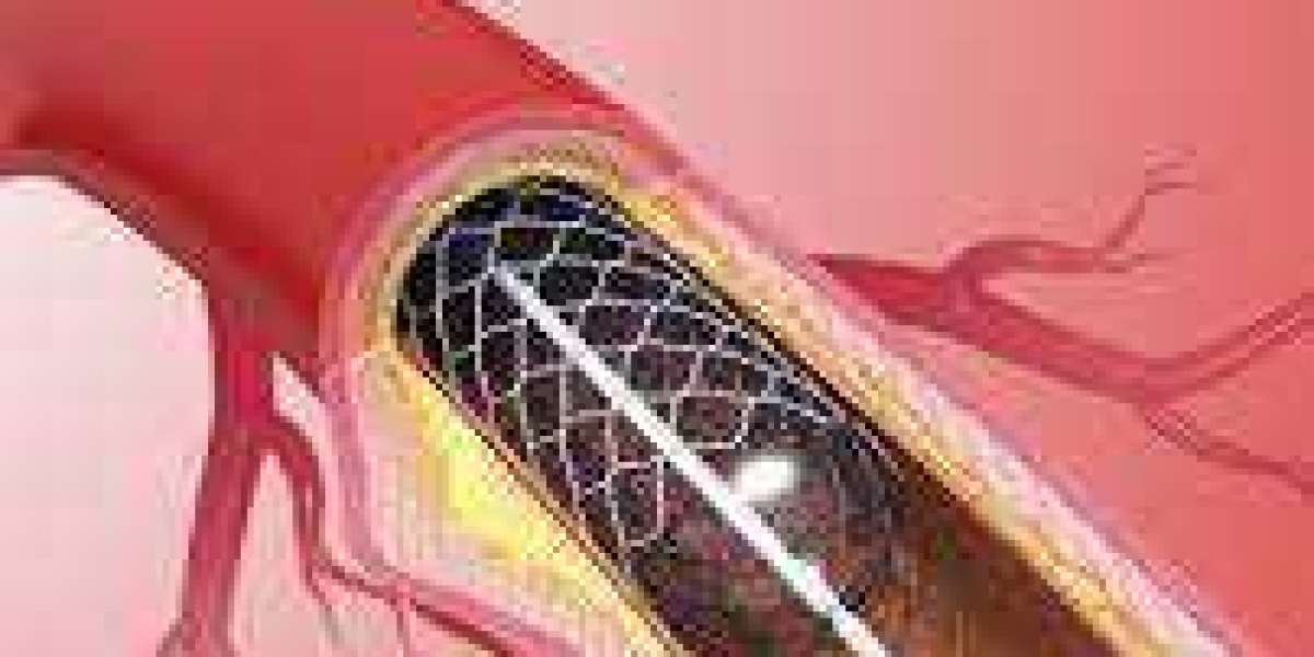 Expert Coronary Angioplasty in Jaipur: Advanced Cardiac Care