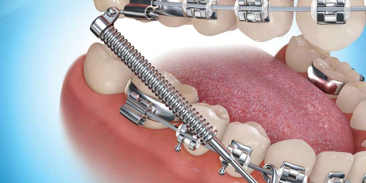 Invisible Orthodontic Appliance Market Share, Trend, Segmentation and Forecast to 2031